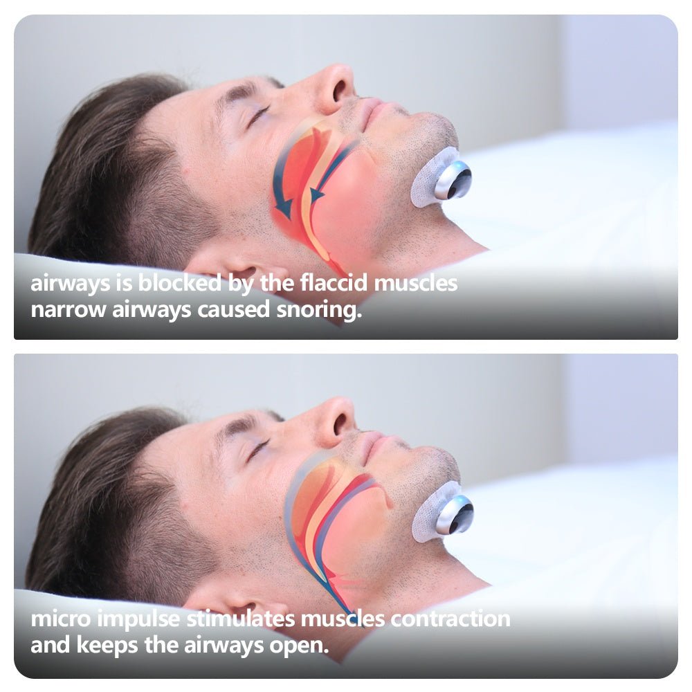 DreamSilence: Smart Anti-Snoring Device