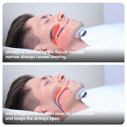 DreamSilence: Smart Anti-Snoring Device